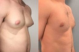 How Much Does Male Breast Surgery Cost Today?