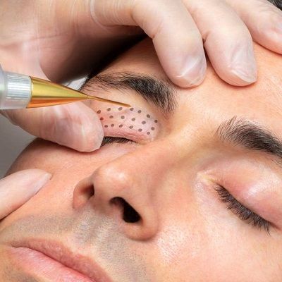 Say Goodbye to Wrinkles: Discover the Power of Plasma Pen