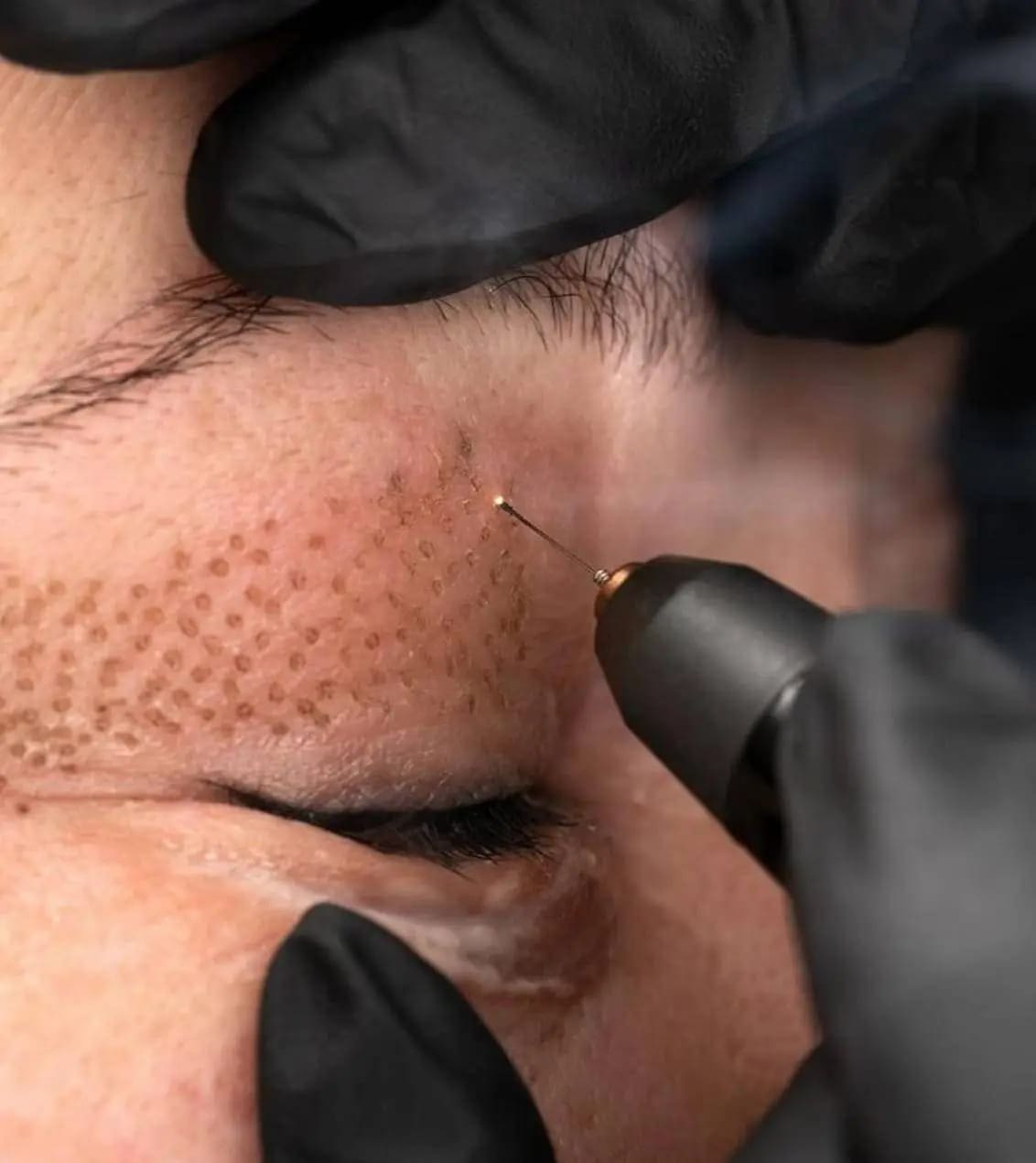 What Is Plasma Pen Treatment? Ultimate Guide for Beginners