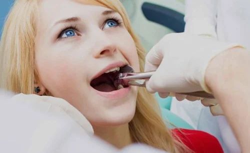 Can Insurance Cover Tooth Extraction in Dubai?