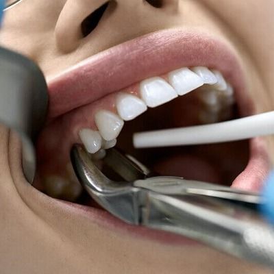 Tooth Extraction: What Influences the Price?