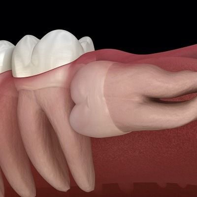 Tooth Extraction in Dubai: A Quick Fix for Long-Term Comfort