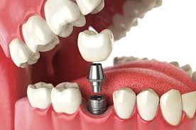 Tooth Extraction Cost in Dubai: What You Need to Know