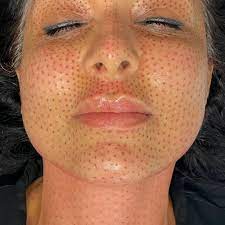 Plasma Pen Treatment: Benefits & Results