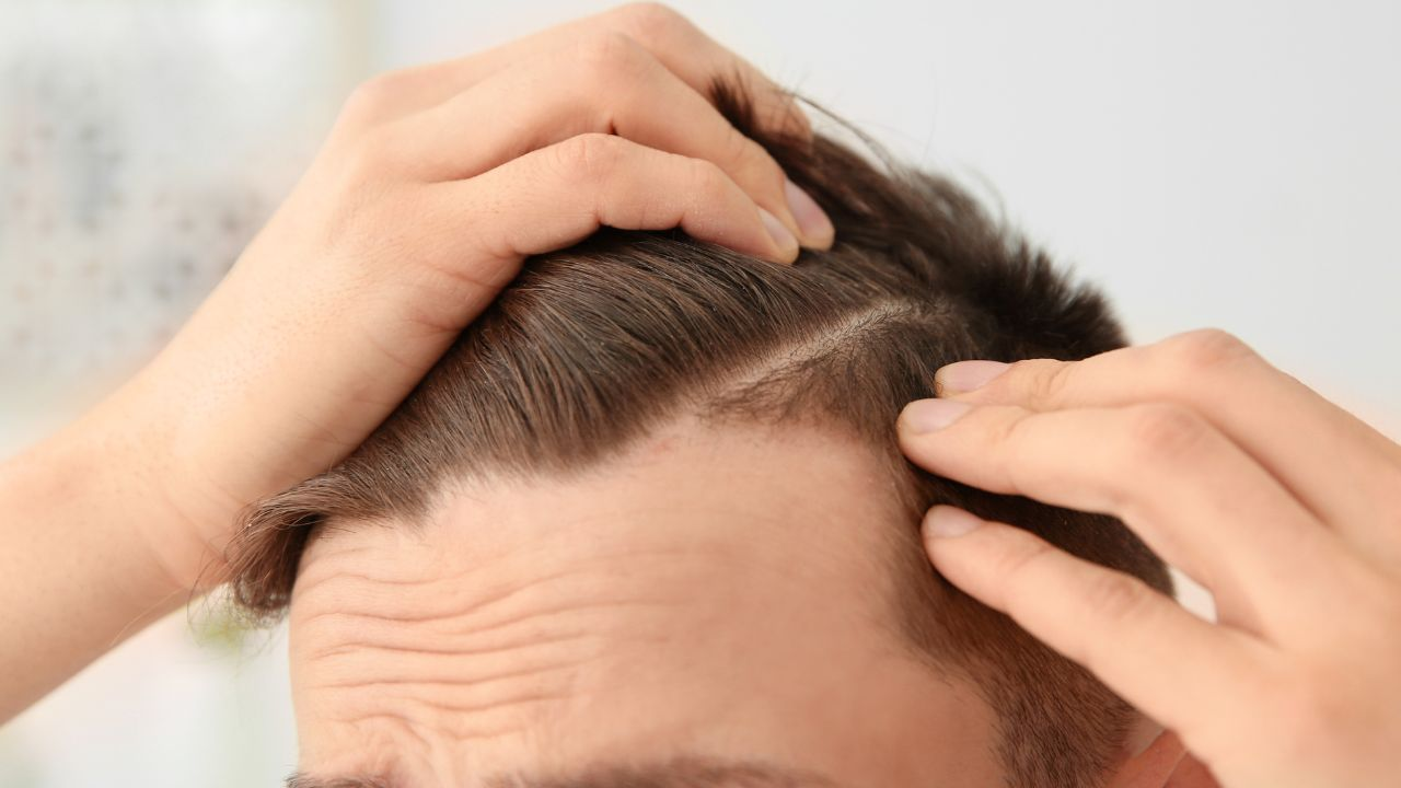 Finasteride for Hair Loss: A Treatment That Actually Works
