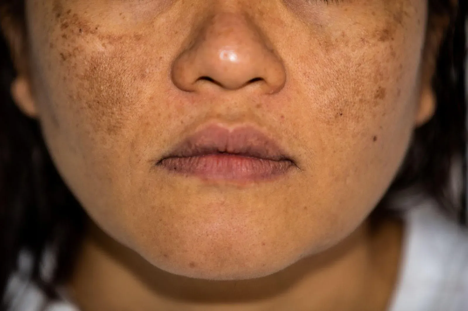 How to Maintain Even Skin Tone After Melasma Fades
