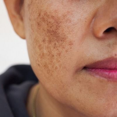 Melasma Skincare Treatments Popular in Dubai