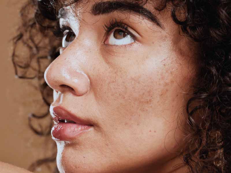 Melasma Treatment in Dubai for All Skin Shades