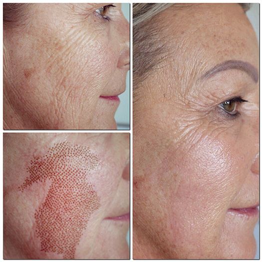 Say Goodbye to Dark Spots with Melasma Treatment