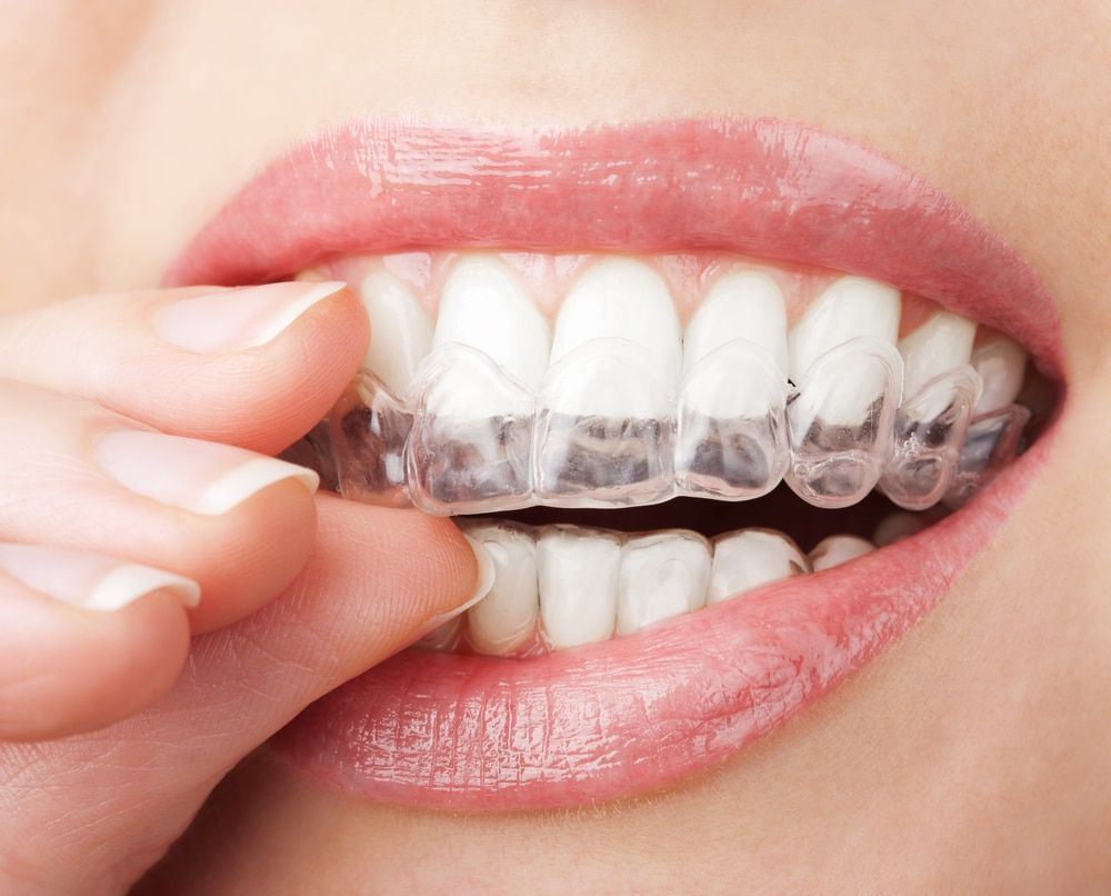 Get the Best Value on Teeth Whitening Cost in Dubai