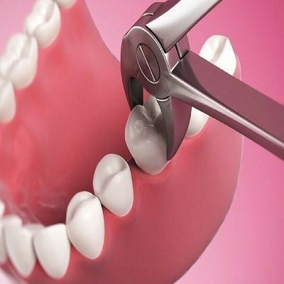 Title: Elevate Your Smile with Tooth Extraction Cost Dubai