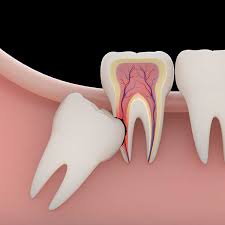 Planning Ahead for Tooth Removal
