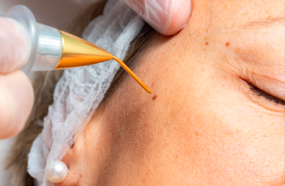 Fast and Painless Wart Removal Services