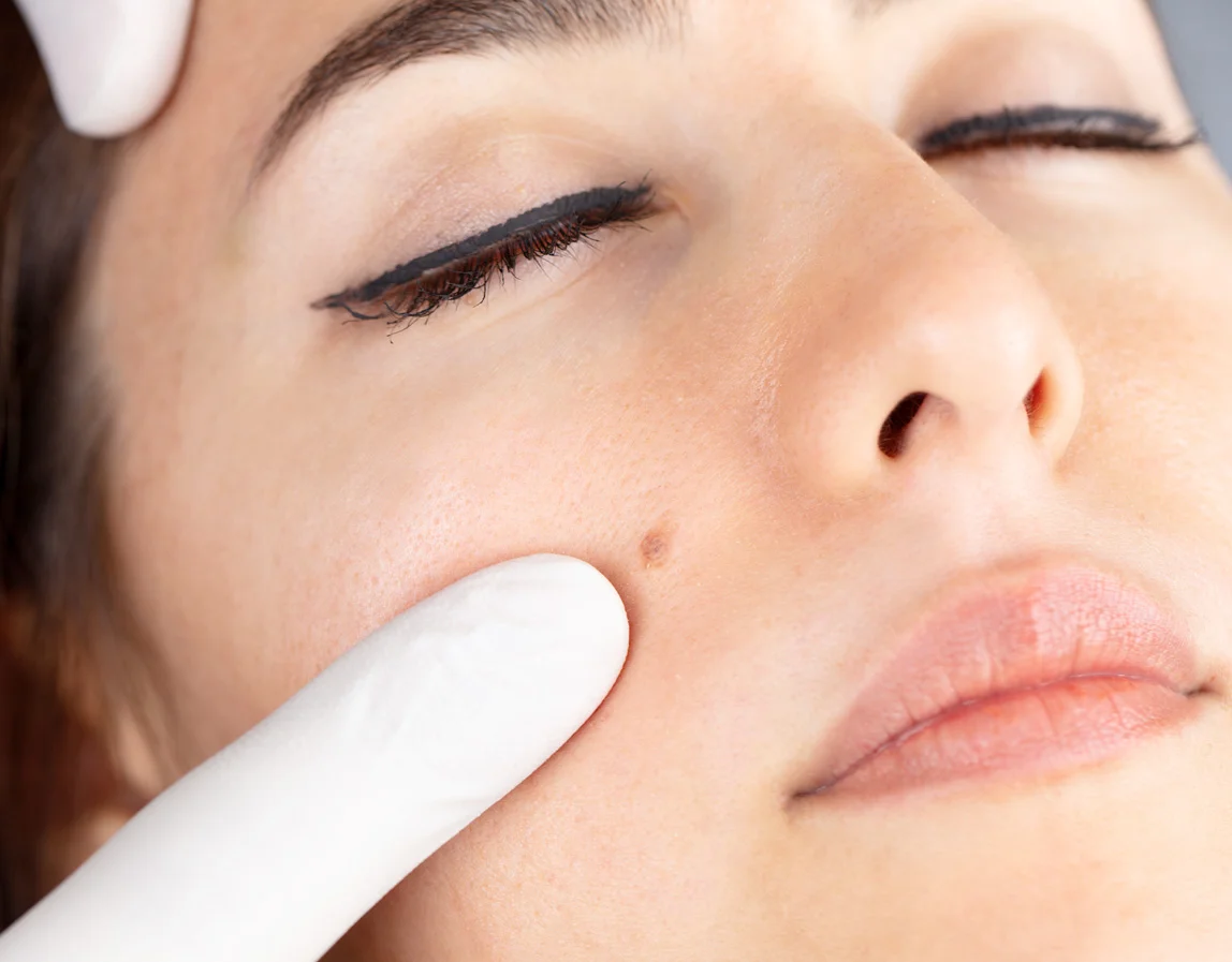 Effective Wart Removal for Sensitive Skin