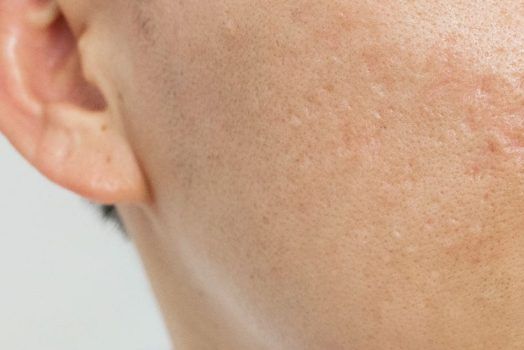 Laser Hair Removal in Islam: Permissible or Not?