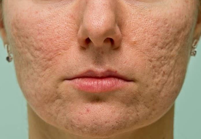 Why Everyone Is Googling Melasma Treatment in Dubai Right Now