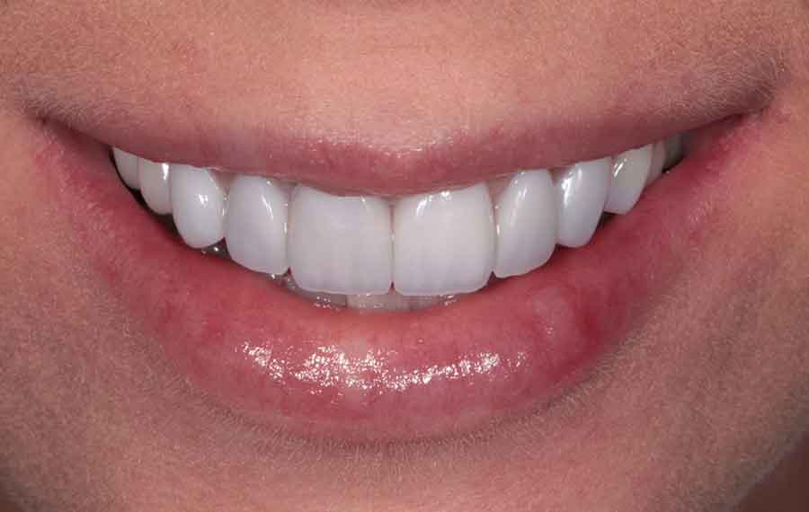 Teeth Whitening Cost in Dubai Everyone’s Talking About