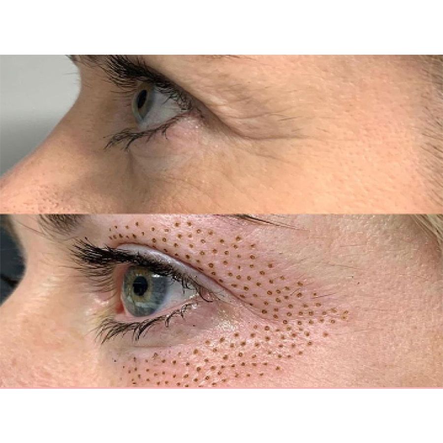 Plasma Pen: How to Maximize Your Skin Tightening Results