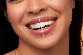 Expert Guide to Teeth Whitening Cost in Dubai