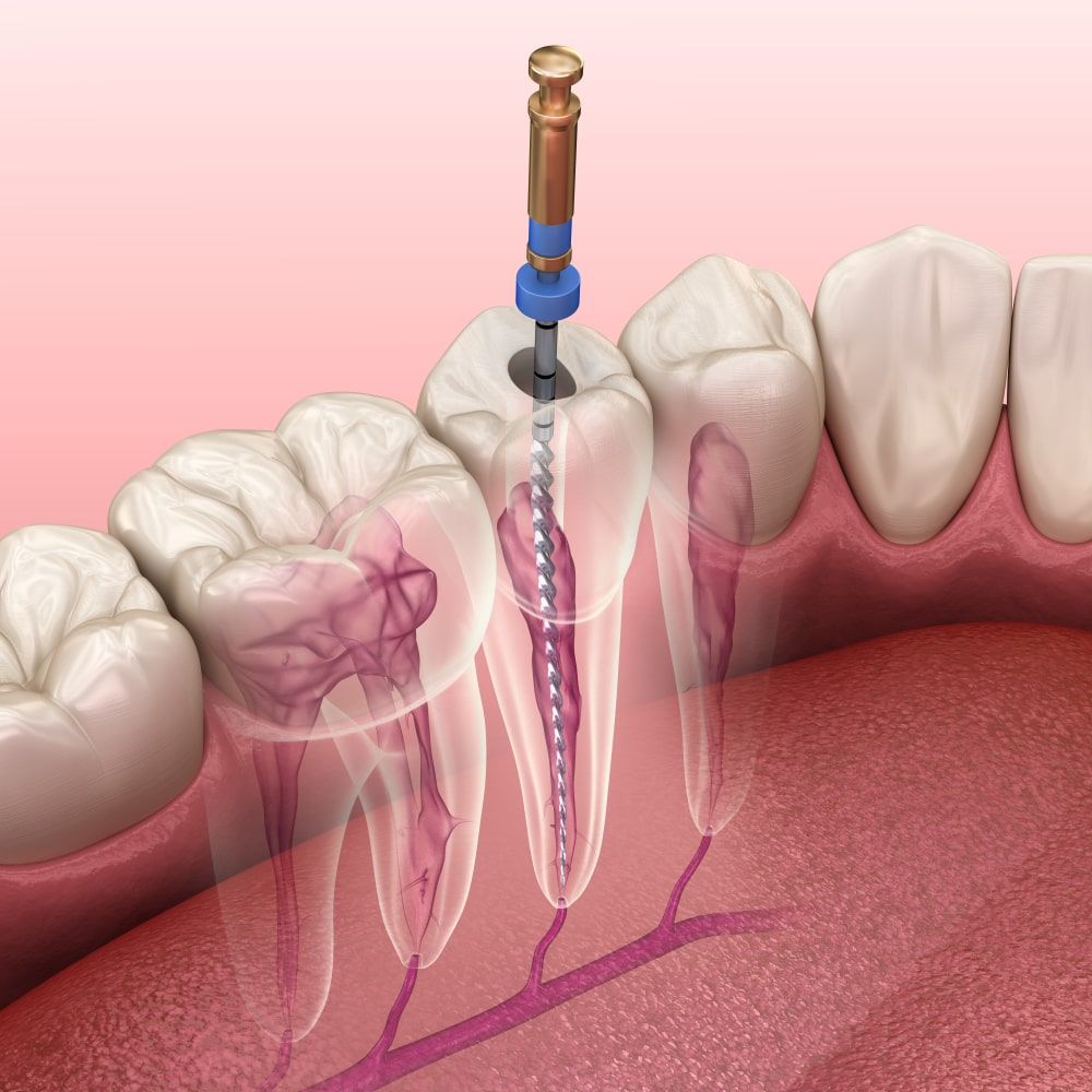 How to Prepare for Root Canal Treatment Comfortably