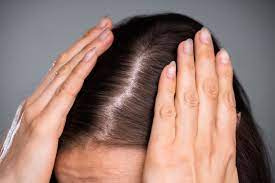 Can Finasteride for Hair Loss Help Restore a Natural Appearance?