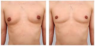 Gynecomastia Surgery Cost Awareness Builds Smart Decisions