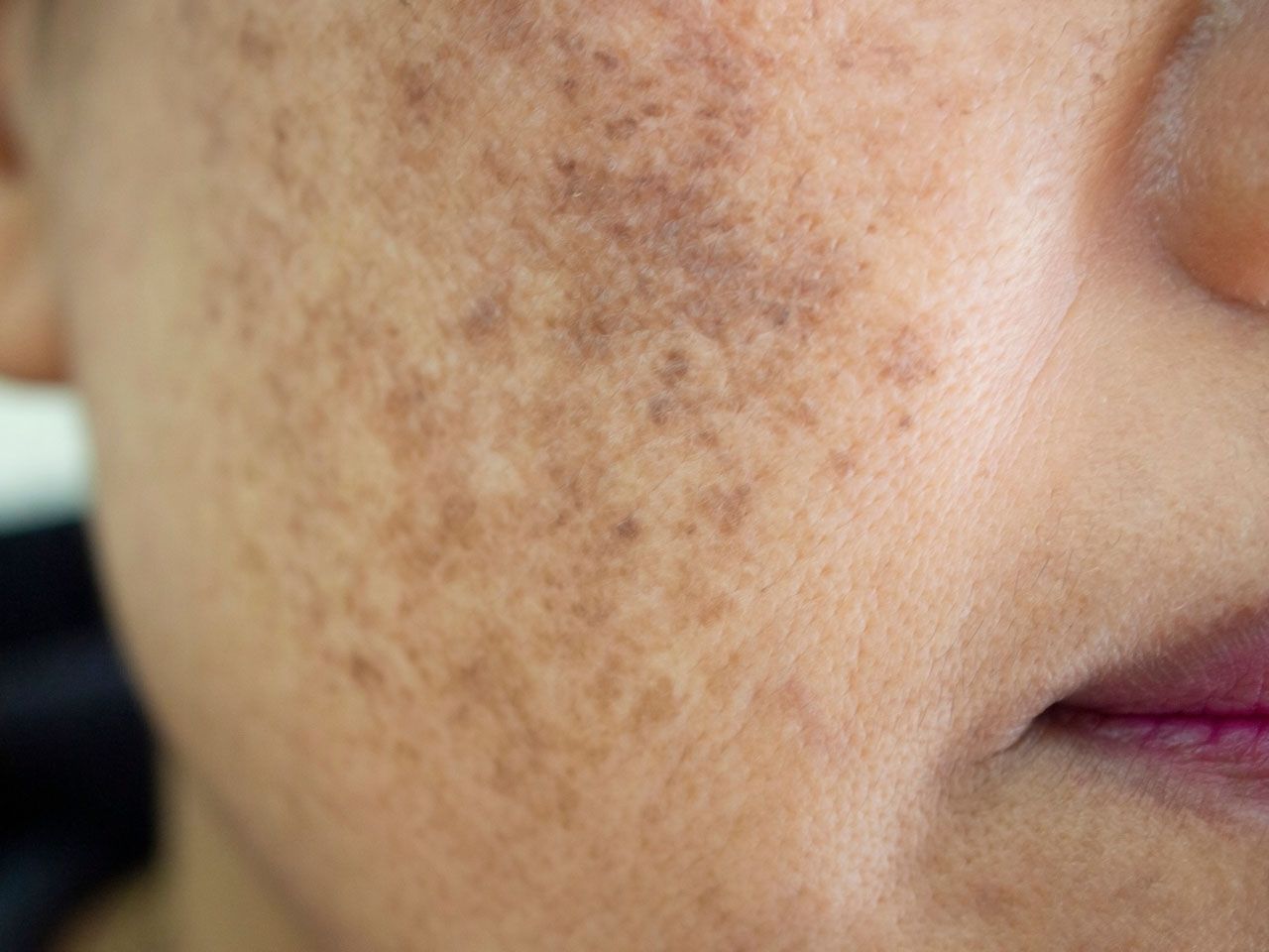 Transform Your Glow Experience With Melasma Treatment