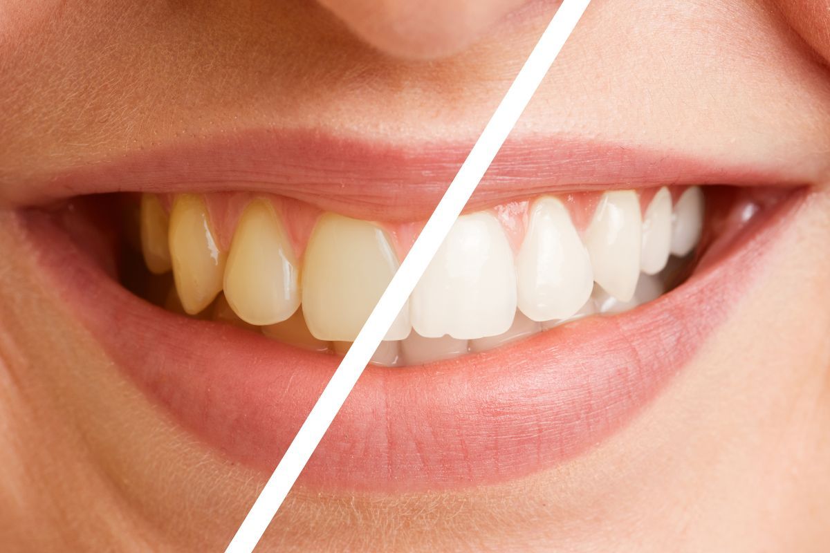 Shine Smile Radiance Smoothly Through Teeth Whitening Cost Secrets
