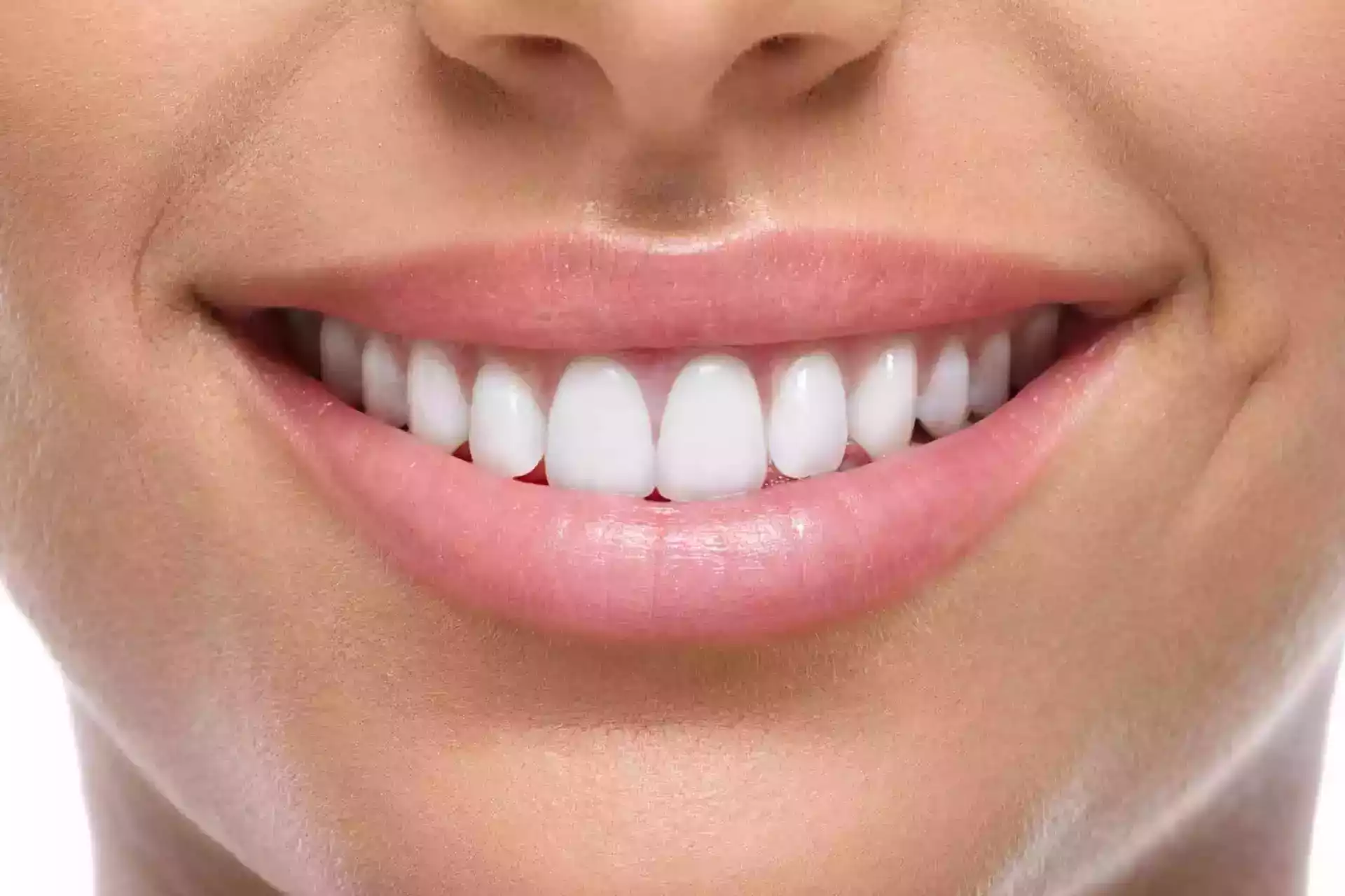 Smile with Pride Thanks to Perfect Composite Veneers