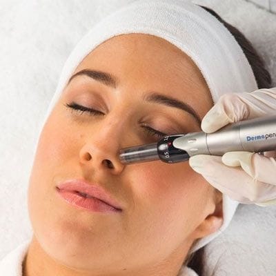 Plasma Pen Treatment Refreshes and Revitalizes Skin Naturally Today